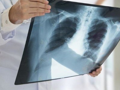 119 адамнан коронавирус пневмониясы анықталды