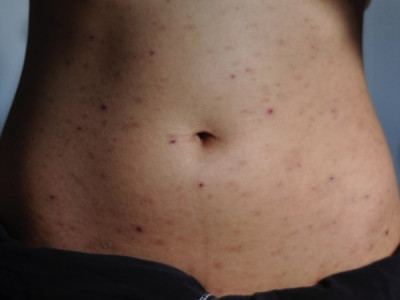 Пятна на коже, говорящие о циррозе печени