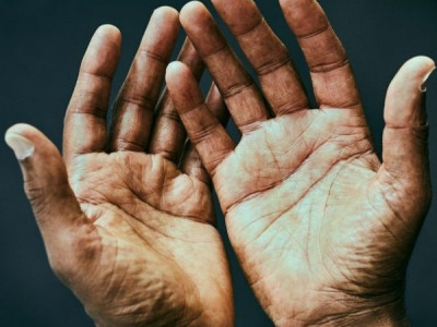 Дефицит B12 - развивается медленно: как узнать о рисках