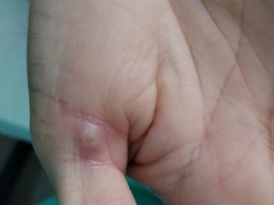 Маймыл шешегін жұқтырғандар саны, тіпті көп болуы мүмкін - ДДСҰ 