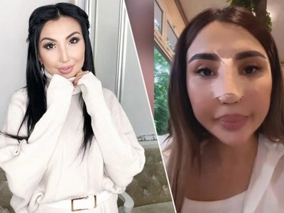 Әнші Сиви Махмуди мұрнын сындырды