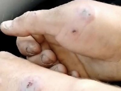 Қостанайлықтар сібір жарасын жұқтырғандар туралы қорқынышты видео таратты