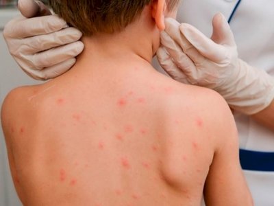 Алматы облысында қызылша жұқтырғандар көбейді