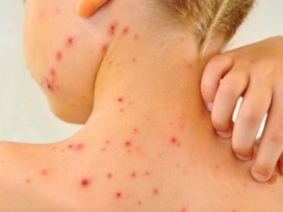 Эпидемиологиялық жағдай күрделі: қызылшамен 23 870 адам ауырған
