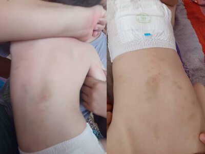 Ақтауда ерекше баланың денесі балабақшадан көкала қойдай көгеріп келген