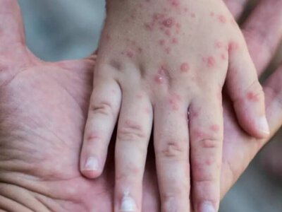 Батыс Қазақстанда қызылшамен ауырғандар саны 16 есе өсті